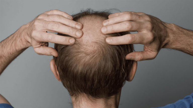 Ni minoxidil ni finasterida: este es el fármaco que podría cambiar las reglas de la alopecia