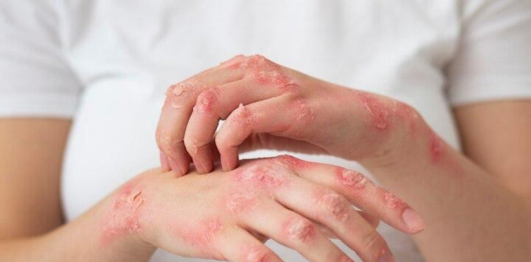 Día Mundial contra la Lepra: Cuando se cura la enfermedad y no el estigma