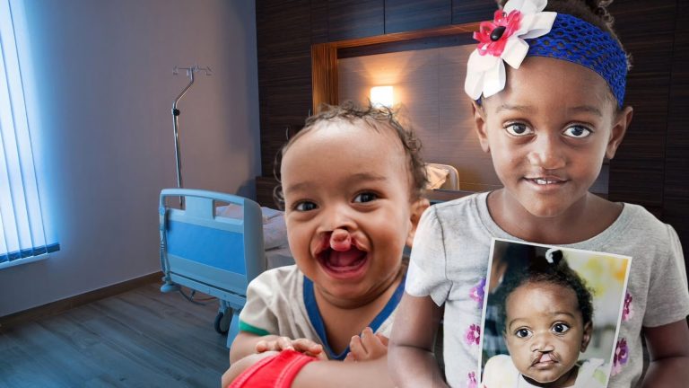 Inicia jordana gratuita para operar a niños con labio y paladar hendido en RD