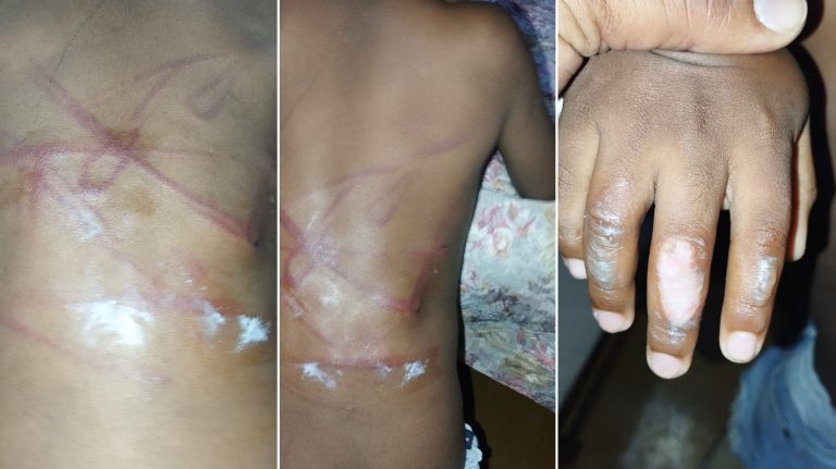 Fiscalía de Moca investiga presunto maltrato contra niño de 5 años en Veragua