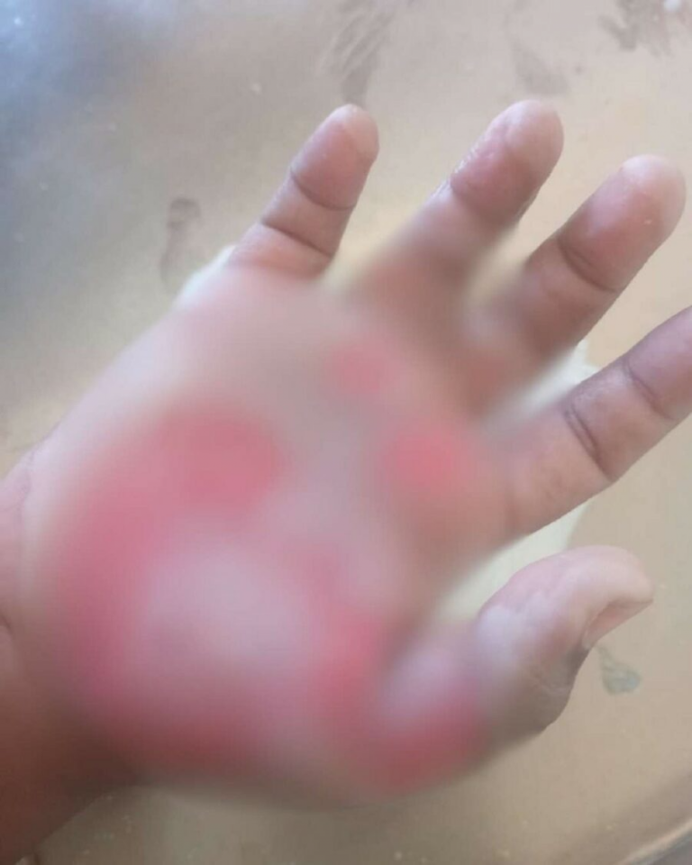 CONANI aboga porque madrastra que quemó mano de niña reciba todo el peso de la justicia