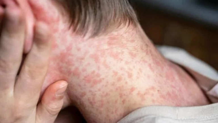 México supera los 10.000 casos de sarampión en un brote que ha provocado 31 fallecidos