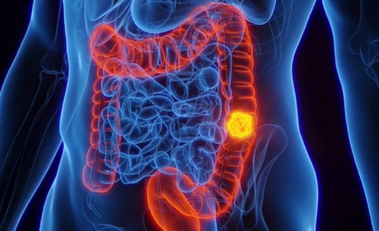 Identifican proteína en sangre que detecta cáncer colorrectal con 70 % de precisión en PR