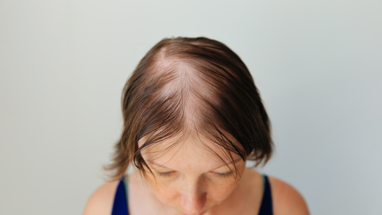 Recuperar el cabello en la menopausia sí es posible