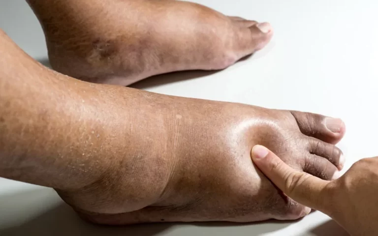 El pie diabético: un drama silencioso