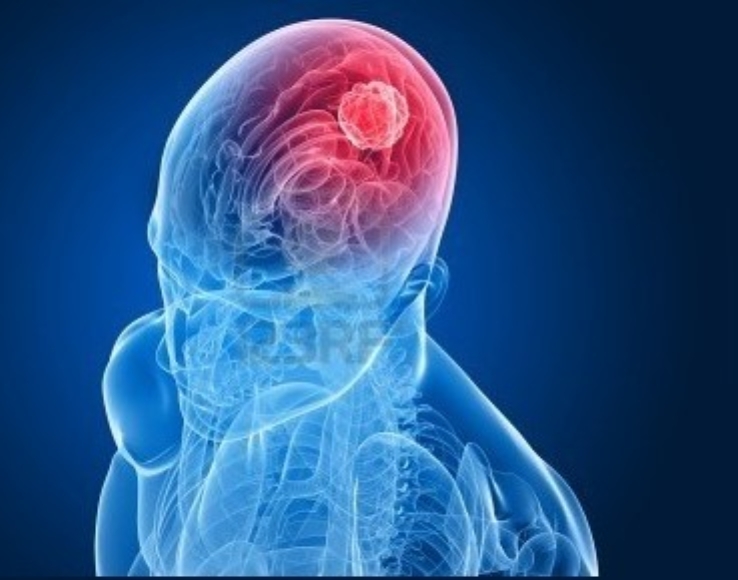 Tumores de cabeza y cuello: hablan, incluso cuando no lo escuchas